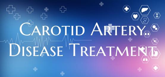 Carotid Artery Disease Treatment