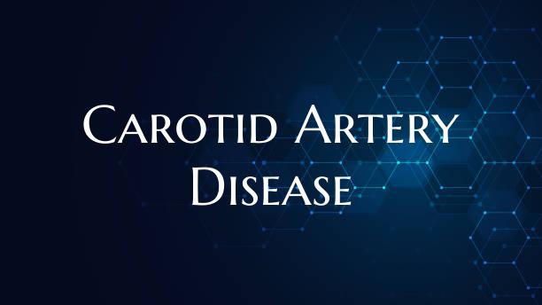 Carotid Artery Disease